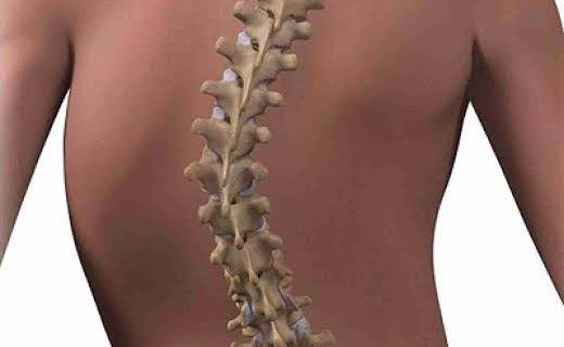 Efek Jangka Panjang Jika Terkena Skoliosis
