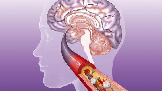 Kenali Faktor Penyebab Di Balik Penyempitan Pembuluh Darah Di Otak