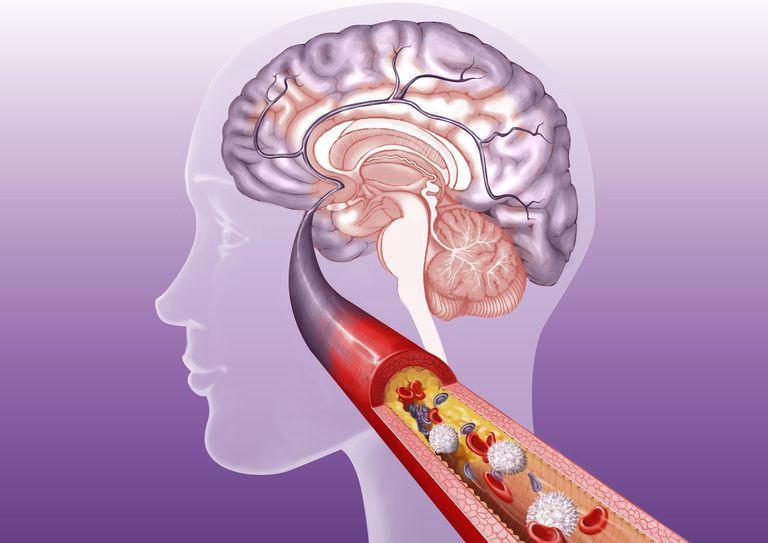 Kenali Faktor Penyebab Di Balik Penyempitan Pembuluh Darah Di Otak