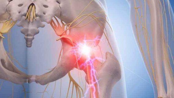 Memilih Cara Pengobatan Piriformis Syndrome Yang Aman