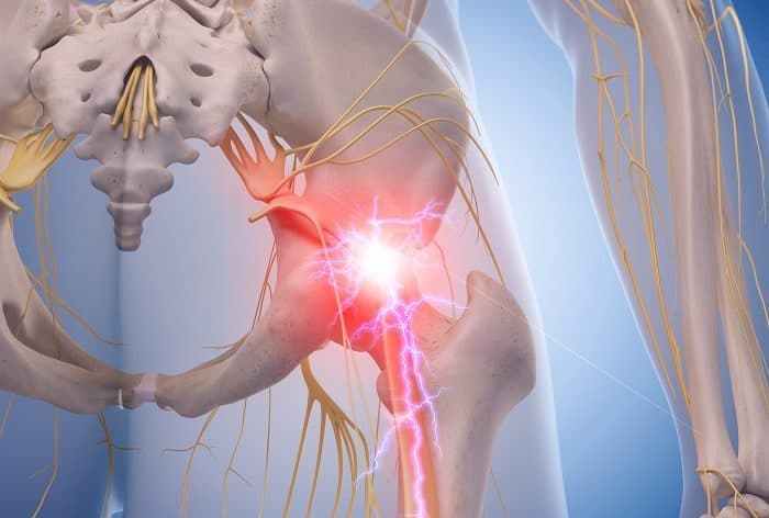 Memilih Cara Pengobatan Piriformis Syndrome Yang Aman