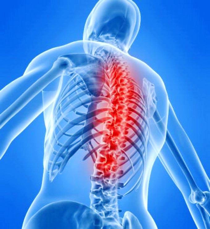 Faktor Penyebab Serta Pengobatan Syaraf Kejepit yang Dilakukan Secara Alami