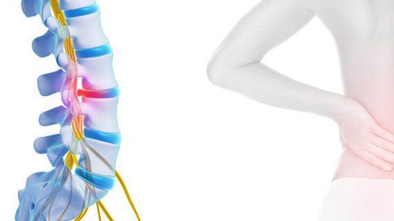 Tempat Pengobatan Syaraf Kejepit Klaten Berpengalaman, Terapi Keluhan Penyakit Syaraf Kejepit Tanpa Operasi