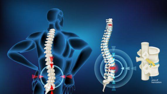 Tempat Pengobatan Syaraf Kejepit di Batam, Sembuhkan Penyakit Syaraf Kejepit Tanpa Operasi