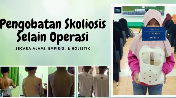 Terapi Skoliosis Ringan | Pengobatan Skoliosis Selain Operasi Dengan Metode Ini