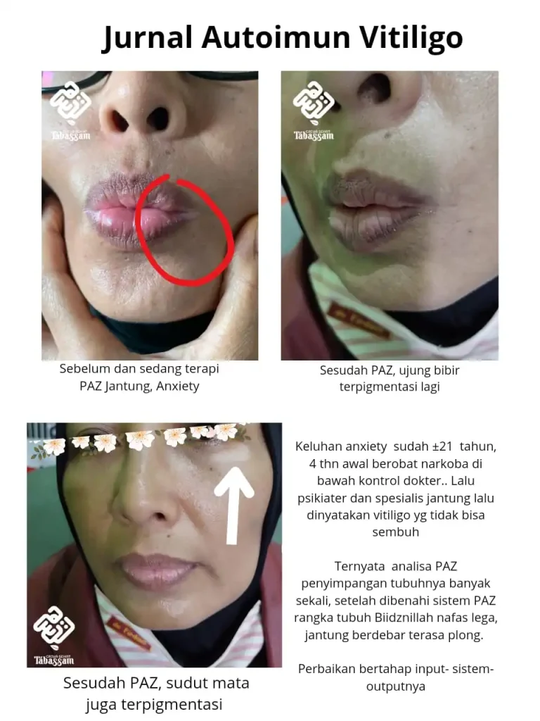 pengobatan vitiligo bisa sembuh paz vitiligo terapi vitiligo