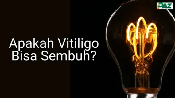 Pengobatan Vitiligo Bisa Sembuh Alami Dengan Terapi PAZ Al Kasaw?