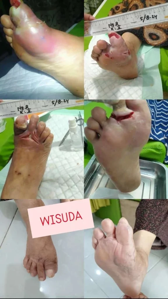 perawatan luka diabetes di rumah