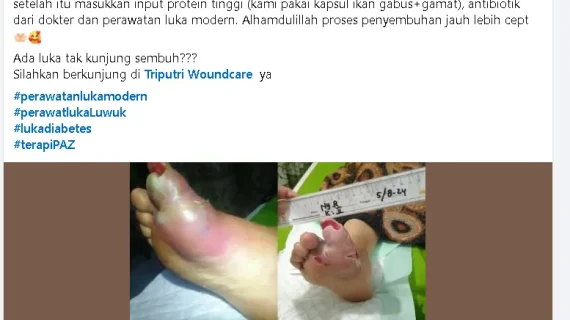 Perawatan Luka Diabetes Melitus + PAZ Lebih Cepat Sembuh