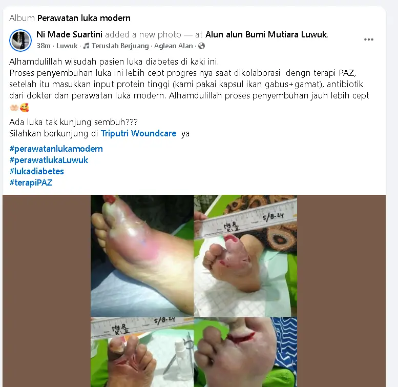 cara perawatan luka diabetes sampai sembuh dengan paz